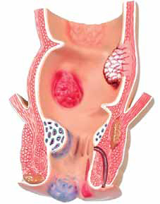 Pathological Model of the Rectum Exporter & Educational Labo
