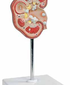 Pathological Model of Renal Calculus Exporter & Educational