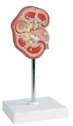 Pathological Model of Renal Calculus Exporter & Educational