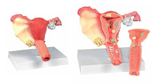 Pathological Model of the Female Reproductive System Exporte