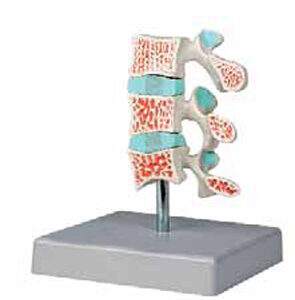 Advanced Osteoporosis Model Exporter & Educational Laborator