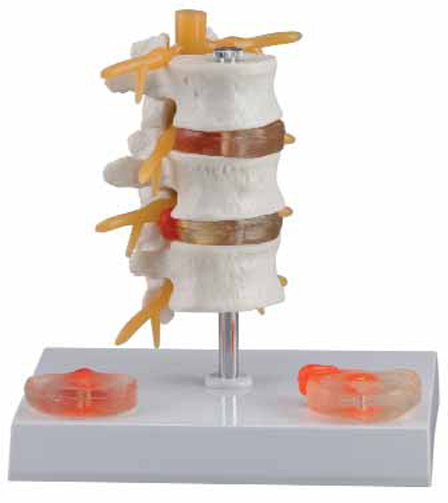 3 Lumbar Vertebrae with Hernia and Prolapsed Intervertebral