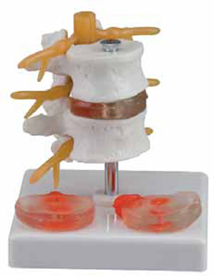 2 Lumbar Vertebrae with Hernia and Prolapsed Intervertebral
