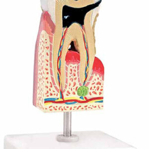 Lower Molar with Caries Exporter & Educational Laboratory Eq