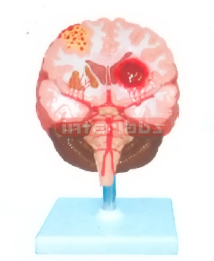 BRAIN STROKE DEMONSTRATION MODEL Manufacturers and Suppliers From Ambala India