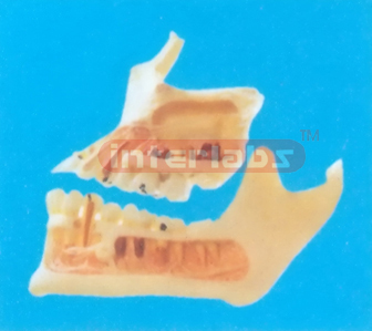 DISEASE MODEL FOR HALF OF THE UPPER AND LOWER JAW Manufacturers and Suppliers From Ambala India