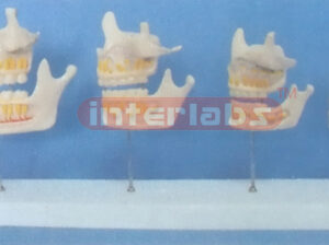 DIFFERENTIAL DENTITION DEVELOPMENT (4 PCS) Manufacturers and Suppliers From Ambala India