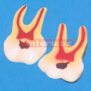 GIANT CARIES MOLAR