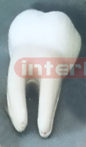 GIANT MOLAR