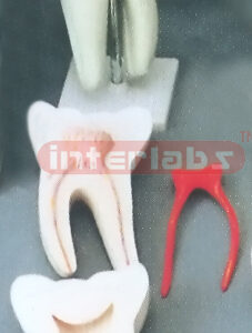 GIANT CARIES MOLAR. 3 PCS / SET. Manufacturers and Suppliers From Ambala India