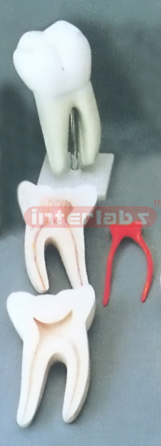 GIANT CARIES MOLAR. 3 PCS / SET. Manufacturers and Suppliers From Ambala India