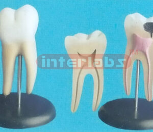 GIANT HEALTH AND CARIES MOLAR MODEL