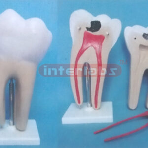 GIANT CARIES MOLAR