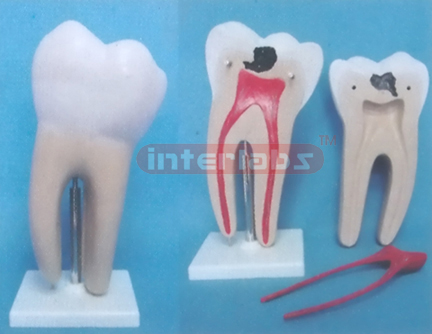 GIANT CARIES MOLAR