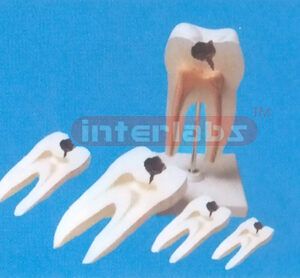 MIDDLE CARIES MOLAR