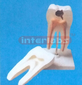 MIDDLE CARIESAND HEALTH MOLAR