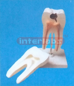 MIDDLE CARIESAND HEALTH MOLAR