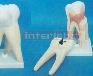 WEST-STYLE CARIES MOLAR MODEL WITH SQUARE PLASTIC BASE (3 PCS / SET) Manufacturers and Suppliers From Ambala India
