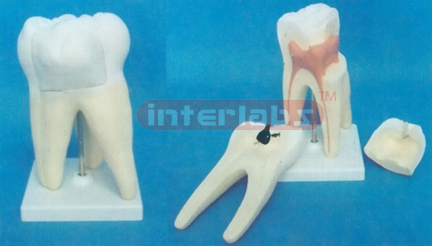 WEST-STYLE CARIES MOLAR MODEL WITH SQUARE PLASTIC BASE (3 PCS / SET) Manufacturers and Suppliers From Ambala India