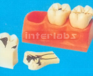 DENTAL CANIES DECOMPOSITION TOOTH MODEL Manufacturers and Suppliers From Ambala India