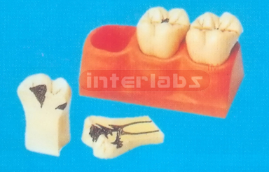 DENTAL CANIES DECOMPOSITION TOOTH MODEL Manufacturers and Suppliers From Ambala India