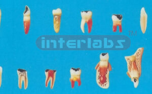 TEETH PATHOLOGIC MODEL CASE OF TEETH ODONTOPATHIES Manufacturers and Suppliers From Ambala India