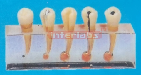 ENDODONTIC DISEASE CLINICAL MODEL Manufacturers and Suppliers From Ambala India