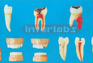 TEETH DISEASE SERIES MODEL Manufacturers and Suppliers From Ambala India