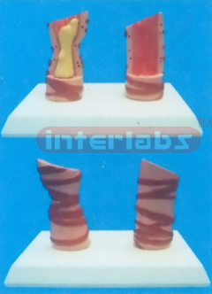 HUMAN HEALTH AND DISEASED TRACHEA COMPARISON MODELS (A TYPE) Manufacturers and Suppliers From Ambala India