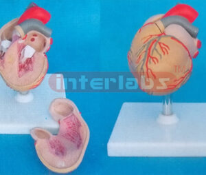 DISEASE HEART WITH LEFT VENTRICULAR HYPERTROPHY (LVH) Manufacturers and Suppliers From Ambala India