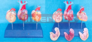 DISEASE HEART VENTRICULAR WITH LEFT VENTRICULAR HYPERTROPHY (LVH) Manufacturers and Suppliers From Ambala India