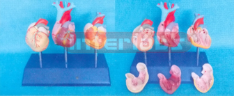 DISEASE HEART VENTRICULAR WITH LEFT VENTRICULAR HYPERTROPHY (LVH) Manufacturers and Suppliers From Ambala India