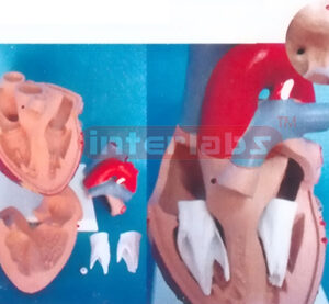 MIDDLE HEART WITH ATRIAL SEPTAL AND VENTRICULAR SEPTAL DEFECTS Manufacturers and Suppliers From Ambala India