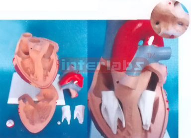 MIDDLE HEART WITH ATRIAL SEPTAL AND VENTRICULAR SEPTAL DEFECTS Manufacturers and Suppliers From Ambala India