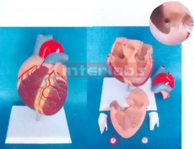 MIDDLE HEART WITH ATRIAL SEPTAL DEFECT Manufacturers and Suppliers From Ambala India
