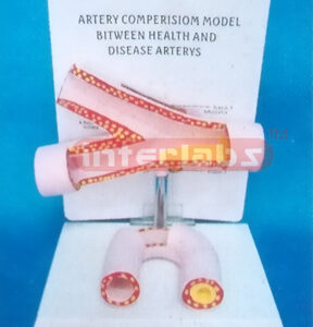 ARTERY COMPARISON MODEL BETWEEN HEALTH AND DISEASE ARTERY Manufacturers and Suppliers From Ambala India