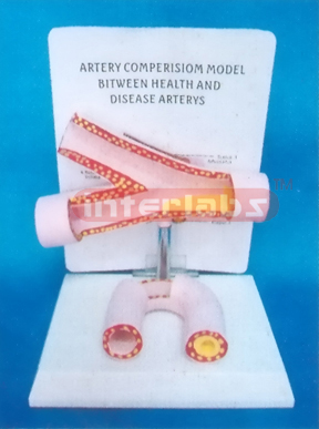 ARTERY COMPARISON MODEL BETWEEN HEALTH AND DISEASE ARTERY Manufacturers and Suppliers From Ambala India