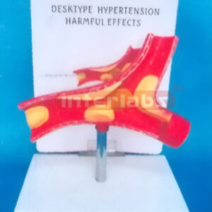 DSKTYPE (HYPERTENSION HARMFUL EFFECTS) DISEASE ARTERY WITH DESCRIPTION PLATE (A TYPE) 6.5 x 11.5 x 16.5cm Manufacturers and Suppliers From Ambala India