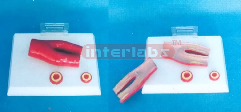 ATHEROSCLEROSIS MODEL WITH CROSS SECTION OF ARTERY (2 PARTS) Manufacturers and Suppliers From Ambala India