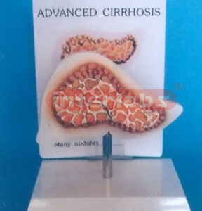 DESK TYPE ADVANCED CIRRHOSIS MODEL WITH DESCRIPTION PLATE Manufacturers and Suppliers From Ambala India