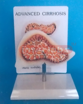 DESK TYPE ADVANCED CIRRHOSIS MODEL WITH DESCRIPTION PLATE Manufacturers and Suppliers From Ambala India