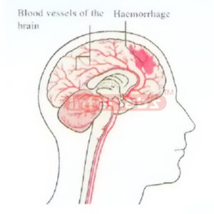 SUDDENLY HAEMORRHAGE MODEL IN HUMAN BRAIN Exporter & Educati