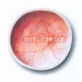 POSTERIOR PART OF THE EYEBALL (INTERNAL ASPECT) MODEL Export