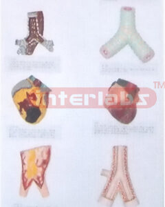 HANGING HUMAN COMPARISION MODEL BETWEEN HEALTH ORGANS AND SMOKING Manufacturers and Suppliers From Ambala India