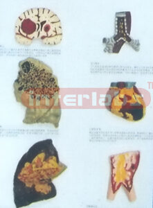 BIG HUMAN THE CONSEQUENCES OF SMOKING HANGING WOODEN PLATE (B TYPE) Manufacturers and Suppliers From Ambala India
