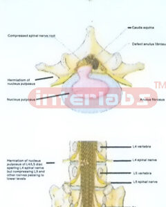HANGING HUMAN HERMIATIONAL DIS MODELS Manufacturers and Suppliers From Ambala India