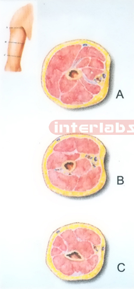 HANGING HUMAN TRANSVERSE SECTION THROUGH THE MIDDLE 1/3 OF THE RIGHT ARM (A