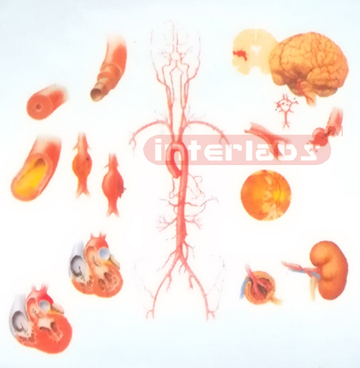 HANGING HUMAN HYPERTENSION DISEASE MODEL FOR DESCRIPTION AND DEMONSTRATION Manufacturers and Suppliers From Ambala India