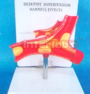 DESKTYPE (HYPERTENSION HARMFUL EFFECTS) DISEASE ARTERY WITH