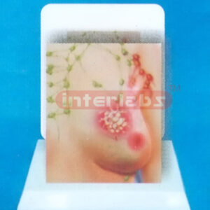 DESK MANARY TUMOR EVOLUTION MODEL WITH DESCRIPTION PLATE (3)